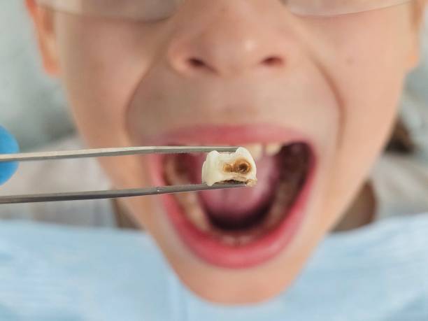 Best Emergency Root Canal Therapy in Humboldt Hill, CA